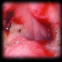 bleedgastric