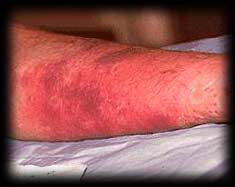 cellulitis