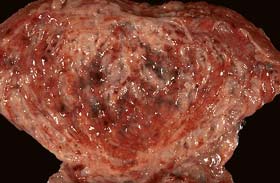 cystitis