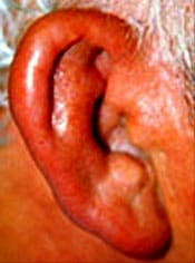 externaotitis