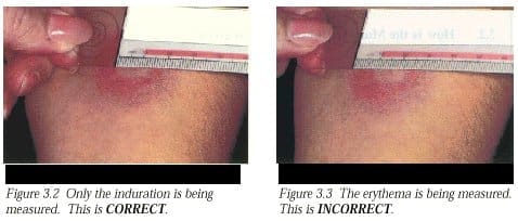 tb test