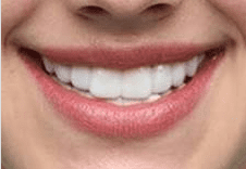 Dental Infections