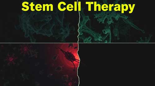 Stem Cell Therapy