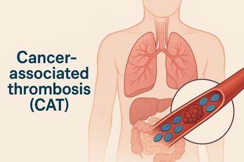 New Anticoagulants vs LMWH in Cancer-Associated Thrombosis: Latest Evidence 4 Cancer-Associated Thrombosis