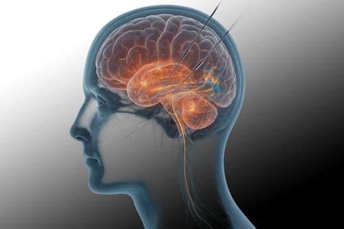 How Deep Brain Stimulation Repairs Neural Pathways to End the Addiction Cycle 2 Deep Brain Stimulation