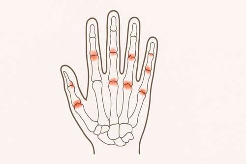 Rheumatoid Arthritis
