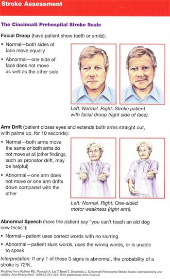 Stroke Scale
