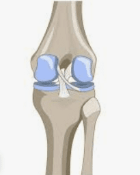 osteoarthritis Osteoarthritis