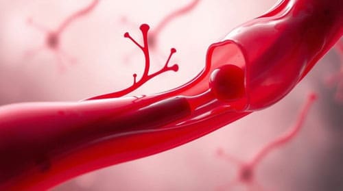 Cancer-Associated Thrombosis